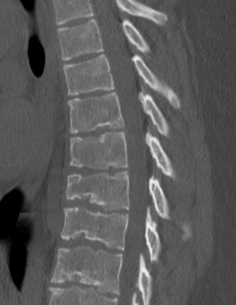 Sagittal CT of the thoracolumbar spine in Scheuermann disease: several adjacent anteriorly wedged vertebrae with irregular endplates and Schmorl nodes. (James Heilman MD, Wikimedia Commons; CC BY-SA 4.0.)