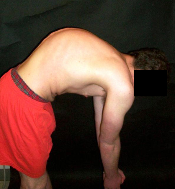 Forward-bend clinical photograph in Scheuermann disease showing a rigid, sharply angular thoracic kyphosis. (Wikimedia Commons; CC0.)