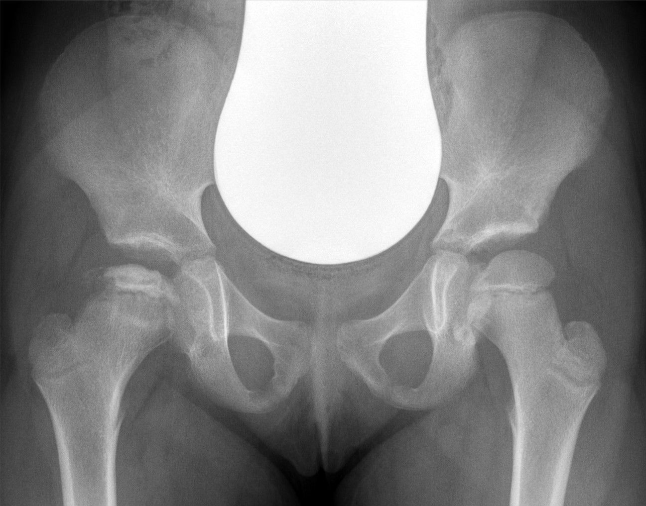 Antero-posterior pelvis of a child with Legg-Calvé-Perthes disease of the right hip: the right capital femoral epiphysis (image left) is small, sclerotic, fragmented and flattened compared with the normal, smoothly ossified left epiphysis. (Hellerhoff, Wikimedia Commons; CC BY-SA 4.0.)