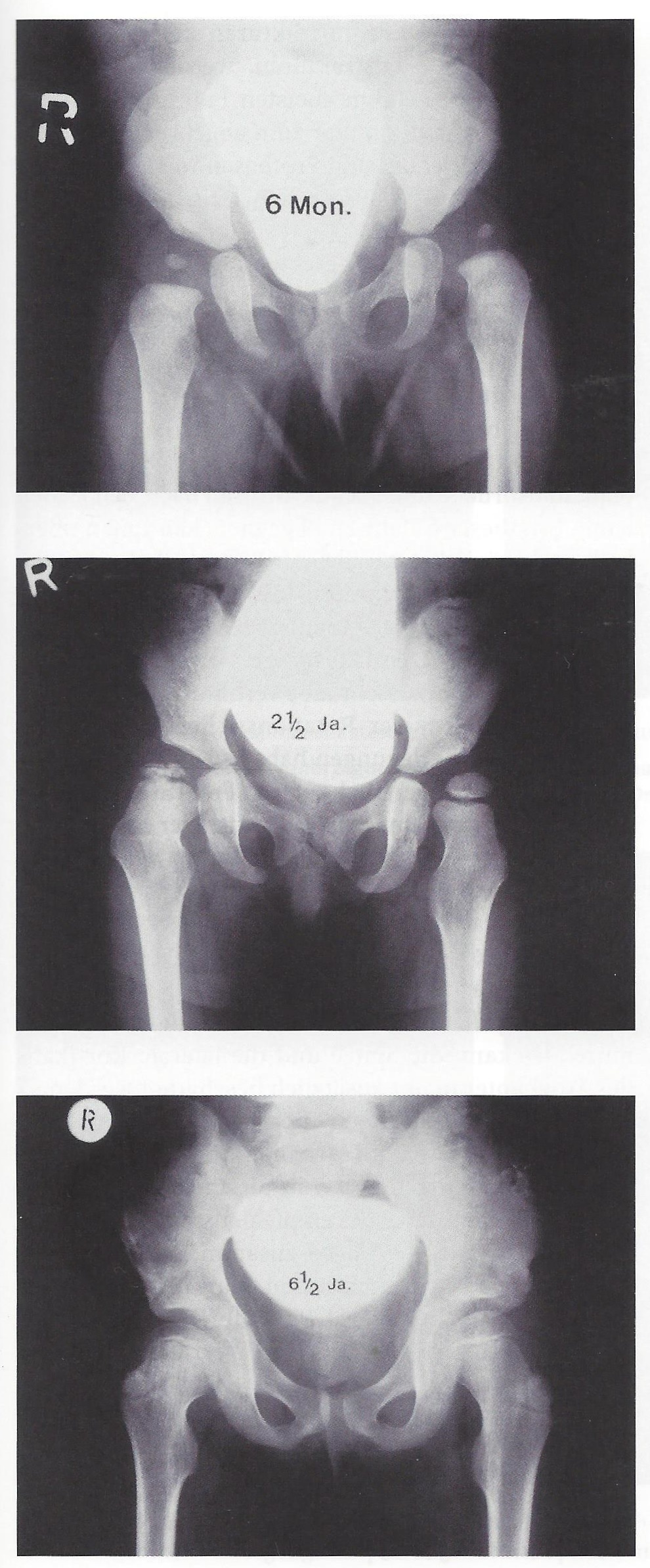 Untreated natural history of right-hip Perthes in one child at 6 months, 2½ years and 6½ years after onset (German labels: Mon. = months, Ja. = years), showing progression through fragmentation to a flattened, enlarged head. (Mehlauge, Wikimedia Commons; CC BY-SA 3.0.)