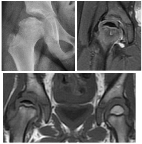 Grade-C Perthes: plain radiograph (coxa plana) with coronal proton-density fat-saturated and T1 MRI; the affected epiphysis shows low T1 signal (necrosis) against the normal contralateral side. (Ruiz Santiago et al., Radiol Res Pract 2016; CC BY 4.0.)