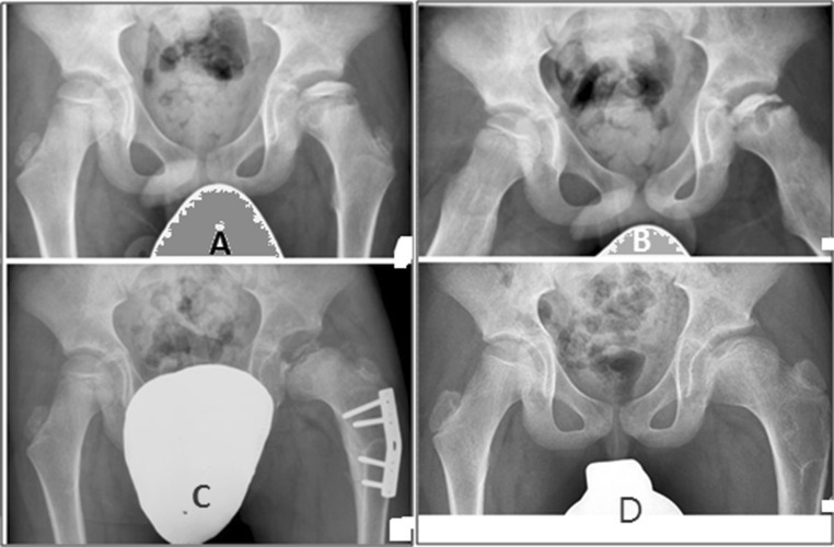 Operative containment for severe Perthes in a 7½-year-old boy (left hip, Catterall IV / lateral pillar C): (A, B) pre-operative AP and frog-leg views; (C) after a proximal-femoral varus osteotomy with a fixation plate; (D) a more spherical head at 48 months. The white shapes are gonad shields. (Elzohairy, J Orthop Traumatol 2016; CC BY 4.0.)