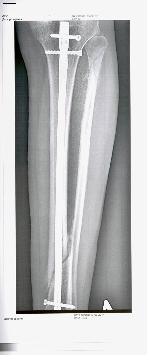 Figure 20. Tibial shaft fracture stabilised with a locked intramedullary nail and interlocking screws, anteroposterior view; the fibula is intact alongside. NiaPol, CC BY 4.0, via Wikimedia Commons.