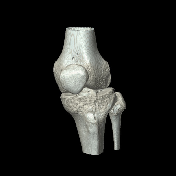 Figure 16. Three-dimensional CT reconstruction of a depressed lateral tibial plateau fracture. LottieLattes, CC BY-SA 4.0, via Wikimedia Commons.