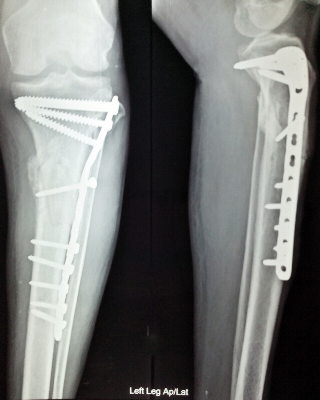 Figure 17. Proximal tibial plateau fracture after open reduction and internal fixation with a buttress plate and screws, anteroposterior and lateral views. Nizil Shah, CC BY-SA 4.0, via Wikimedia Commons.