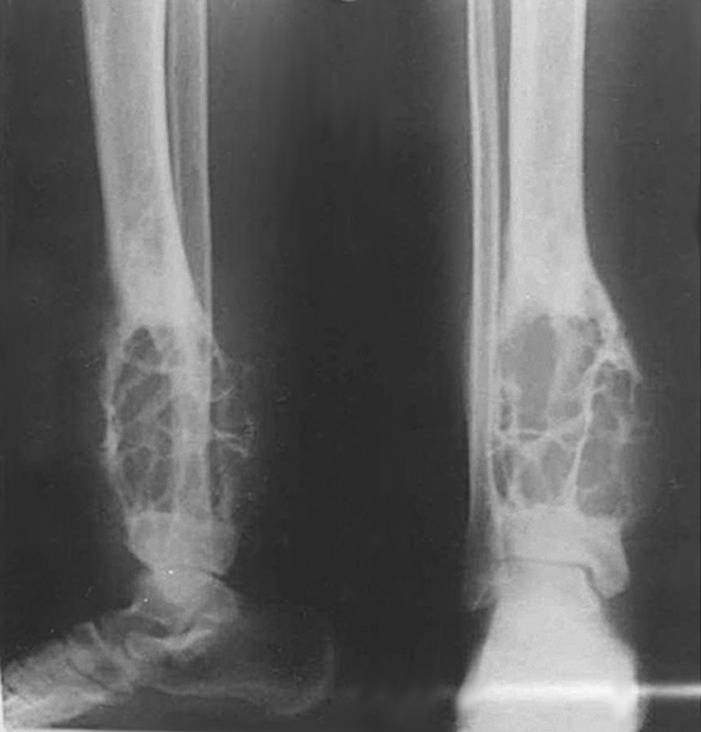 Figure 11. Adamantinoma - multiloculated, expansile “soap-bubble” lytic lesion of the tibia. T-rex89 & Hellerhoff, CC BY-SA 4.0, Wikimedia Commons.