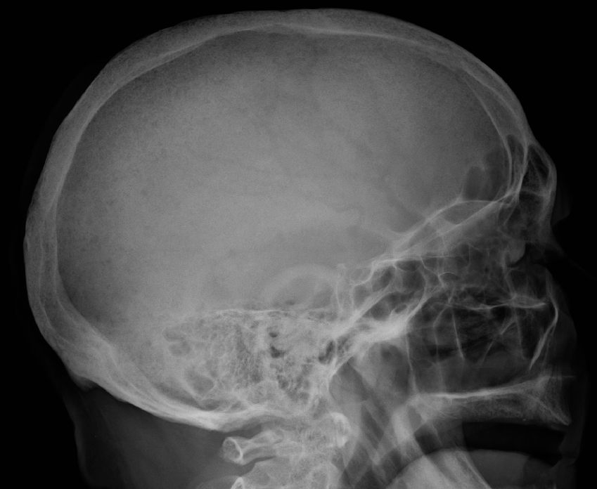 Figure 12. Multiple myeloma - multiple “punched-out” calvarial lucencies (lateral skull). James Heilman, CC BY-SA 4.0, Wikimedia Commons.