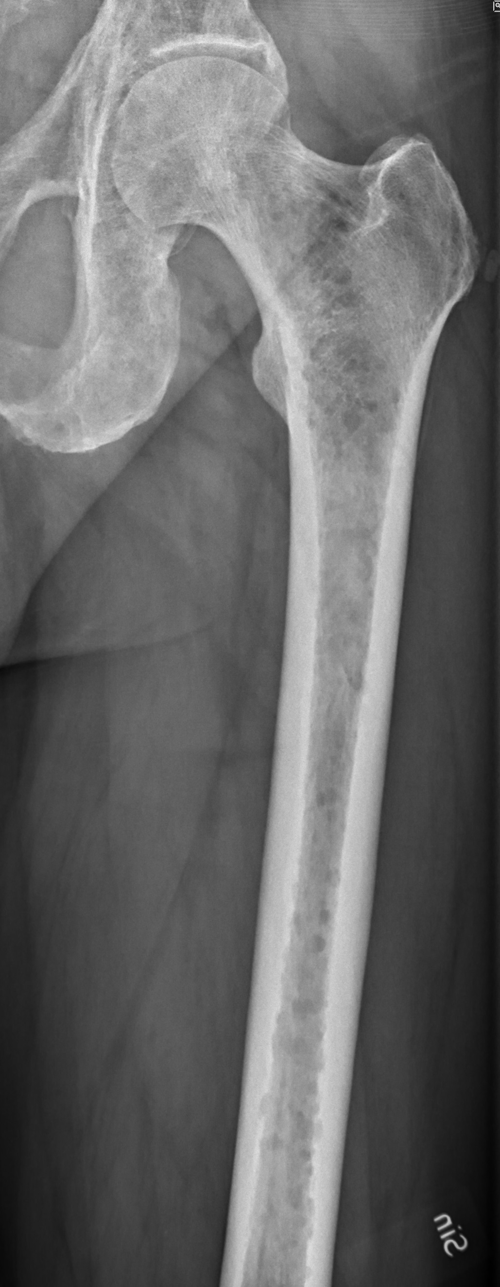 Figure 13. Multiple myeloma - rounded lytic lesions through the femoral shaft and neck. Mikael Häggström, CC0, Wikimedia Commons.
