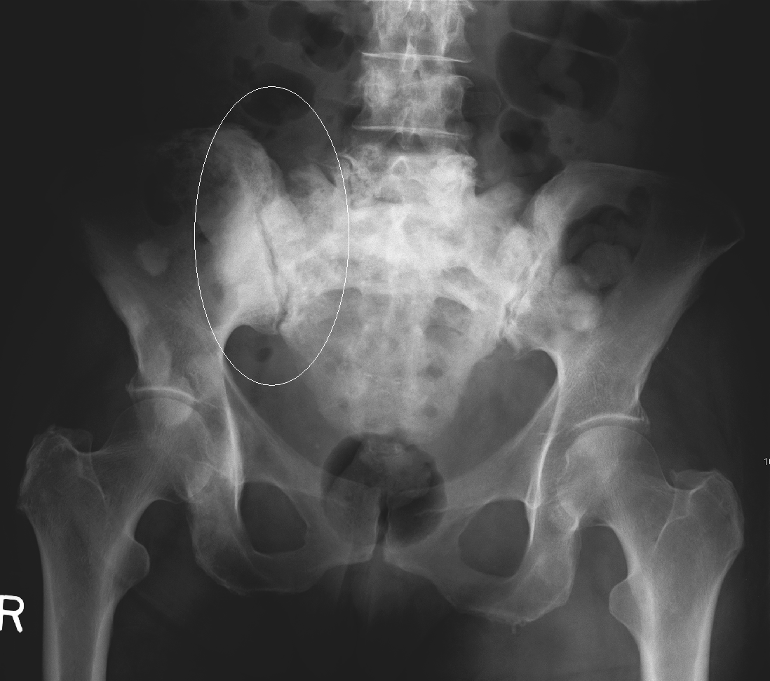Figure 14. Blastic bone metastases - patchy sclerotic deposits in the pelvis (breast primary). James Heilman, CC BY-SA 3.0, Wikimedia Commons.