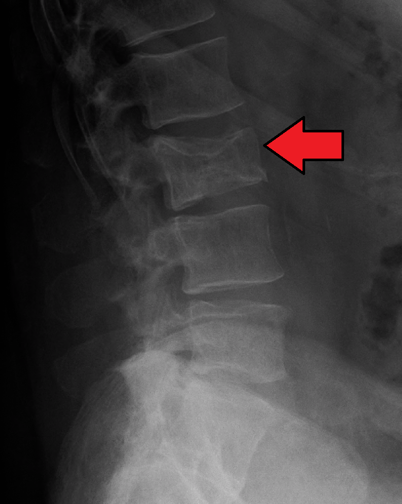 Figure 15. Pathological vertebral fracture - collapsed, wedged lumbar vertebral body. James Heilman, CC BY-SA 4.0, Wikimedia Commons.