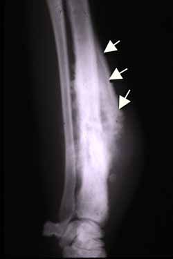 Figure 2. Osteosarcoma - periosteal elevation (Codman triangle, arrows) with sunburst ossification. Ajimsha619, CC BY-SA 3.0, Wikimedia Commons.