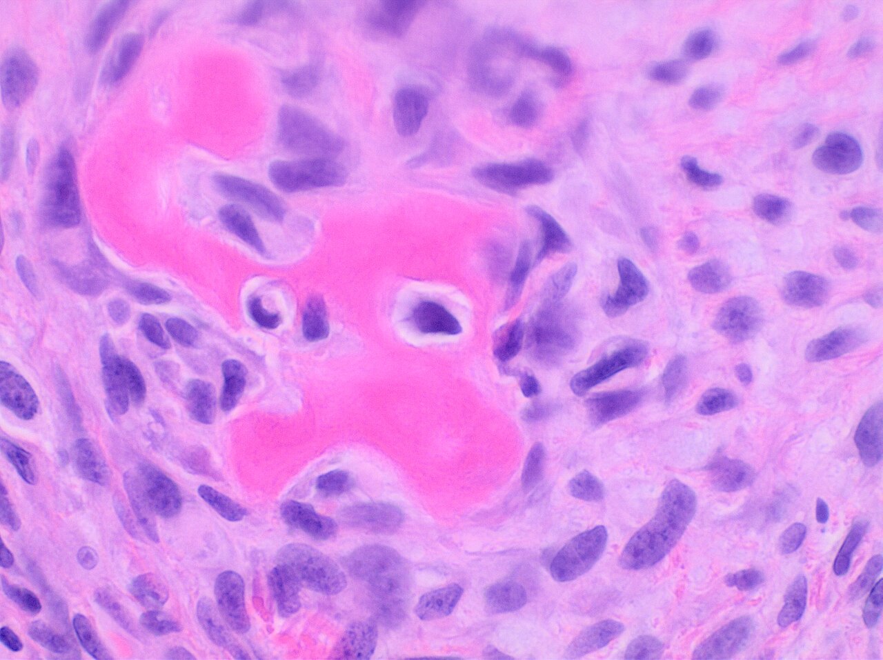 Figure 3. Osteosarcoma - neoplastic osteoid produced by pleomorphic malignant cells (H&E). Mikael Häggström, CC0, Wikimedia Commons.