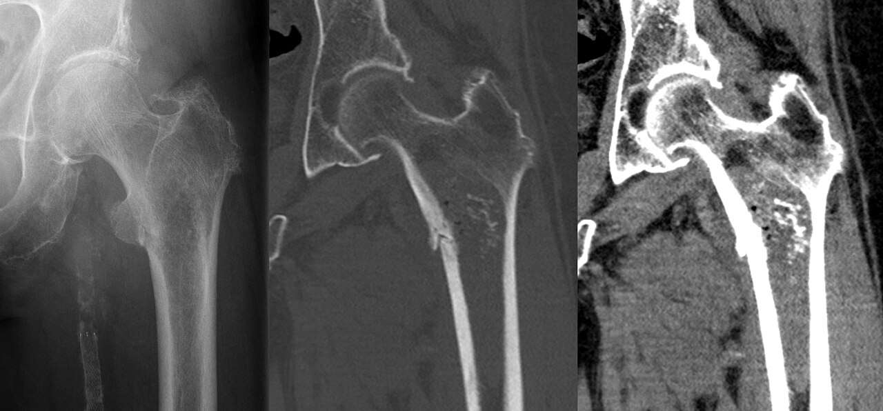 Figure 6. Chondrosarcoma - proximal-femoral lytic lesion with ring-and-arc chondroid calcification (CT) and a pathological fracture. Hellerhoff, CC BY-SA 3.0, Wikimedia Commons.