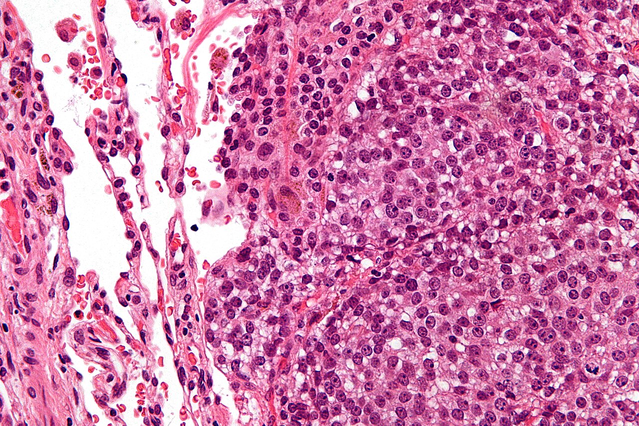Figure 8. Ewing sarcoma - sheets of monotonous small round cells with scant cytoplasm (H&E). Nephron, CC BY-SA 3.0, Wikimedia Commons.