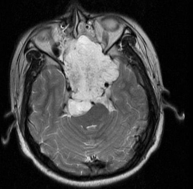 Figure 9. Chordoma - lobulated, markedly T2-hyperintense clival mass extending into the nasopharynx (axial MRI). Hassan et al., CC BY 2.0, Wikimedia Commons.