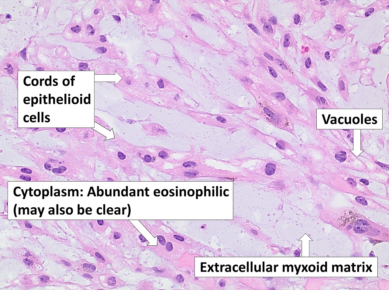 Figure 10. Chordoma - cords of vacuolated physaliphorous cells in a myxoid matrix (annotated H&E). Mikael Häggström, CC0, Wikimedia Commons.