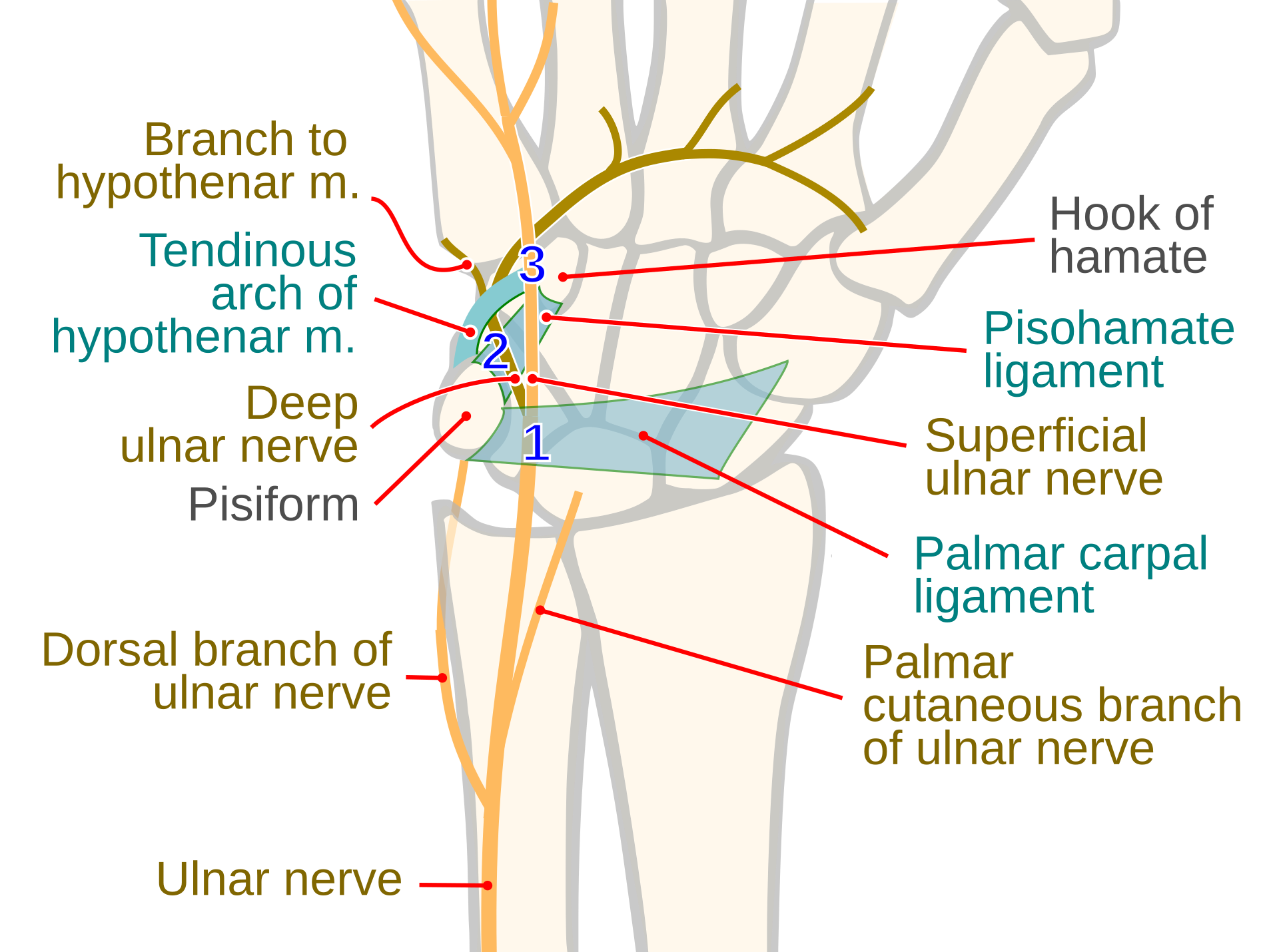 Figure 8. Guyon’s canal: the distal ulnar nerve and its branches around the pisiform and hook of hamate, with the three compression zones labelled. Source: Jmarchn, via Wikimedia Commons, CC BY-SA 3.0.