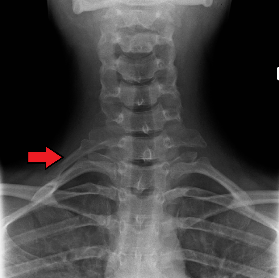 Figure 12. A right-sided C7 cervical rib (arrow), the bony anomaly that predisposes to arterial and true neurogenic thoracic outlet syndrome, often missed on MRI. Source: James Heilman MD, via Wikimedia Commons, CC BY-SA 4.0.