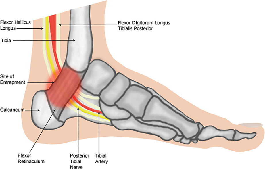 Figure 14. The tarsal tunnel: the posterior tibial nerve passes behind the medial malleolus, deep to the flexor retinaculum, before dividing into the plantar nerves. From Williams et al., via Wikimedia Commons, CC BY 4.0.