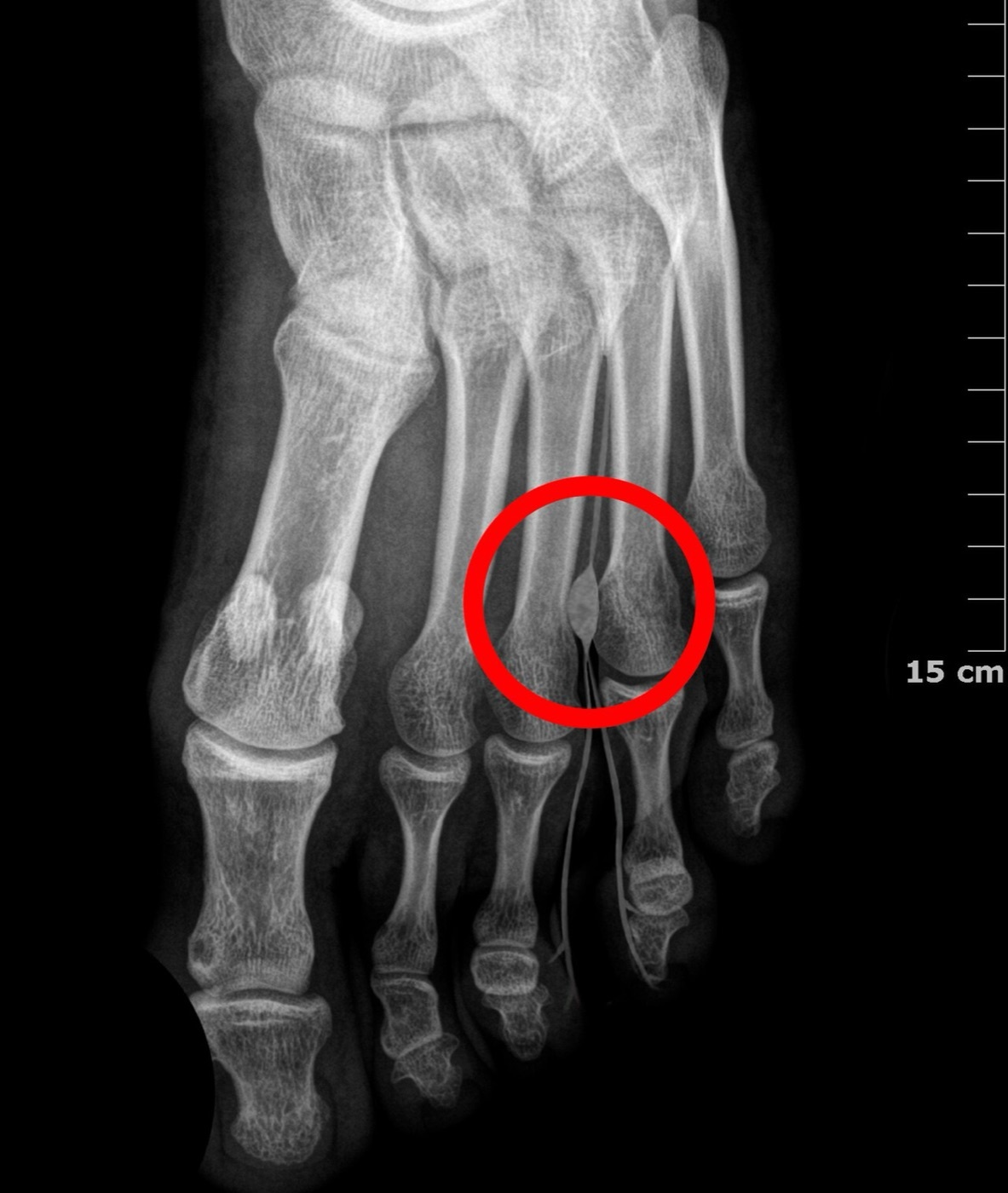 Figure 16. Morton’s (interdigital) neuroma: the classic location in the third intermetatarsal space (circled). Source: N. Z. Cascianini, via Wikimedia Commons, CC BY-SA 4.0.