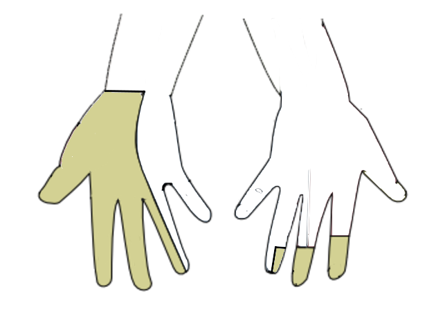 Figure 2. Cutaneous territory of the median nerve (palmar and dorsal): thumb, index, middle and the radial half of the ring finger. Source: Dbult, via Wikimedia Commons, CC BY-SA 4.0.