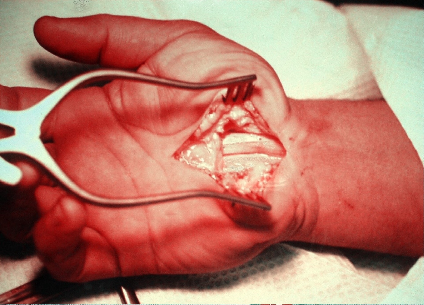 Figure 4. Open carpal tunnel release: the palmar incision exposes the transverse carpal ligament for division. Source: Dr. Harry Gouvas, via Wikimedia Commons, public domain.