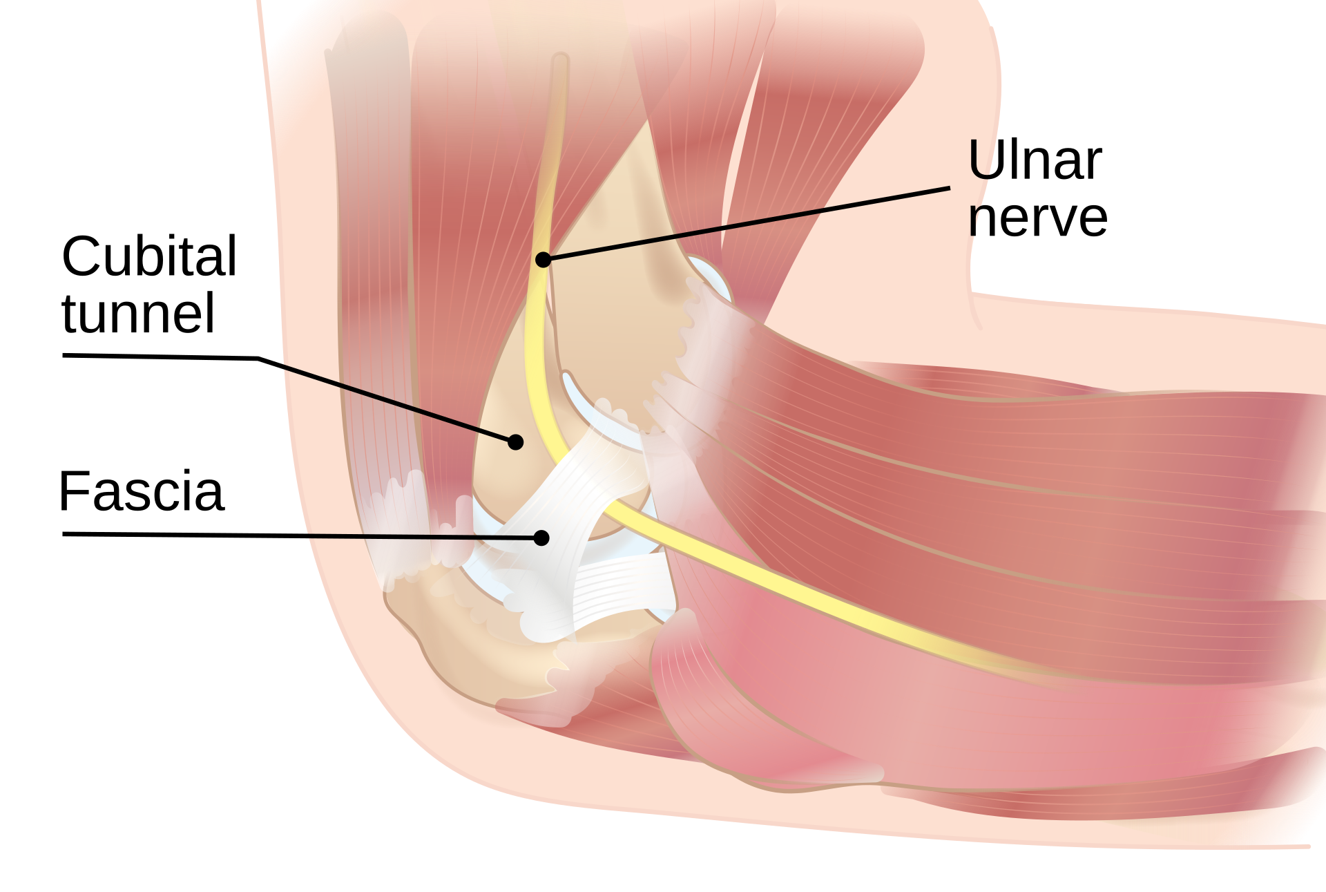 Figure 5. The ulnar nerve passing through the cubital tunnel at the medial elbow, beneath the overlying fascia (Osborne’s band). Source: InjuryMap, via Wikimedia Commons, CC BY-SA 4.0.