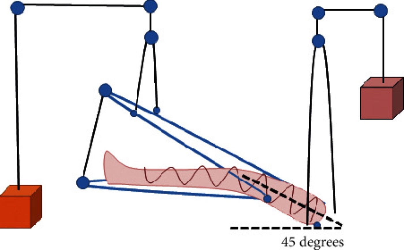 Figure 6. Balanced suspension of the lower limb using a Thomas splint with a Pearson knee attachment, pulleys and weights. From Yuenyongviwat et al. (2020), PMC7396022, CC BY 4.0.