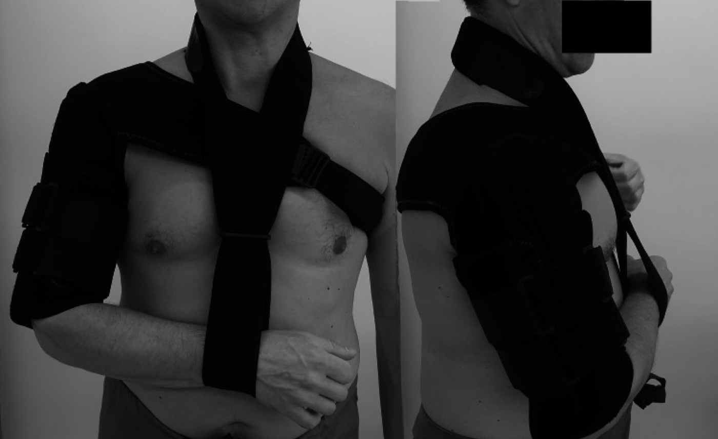 Figure 11. Humeral functional (clamshell) brace with a support sling for conservative treatment of a humeral-shaft fracture - the Sarmiento principle in practice. From Arealis et al. (2021), PMC8174392, CC BY 4.0.