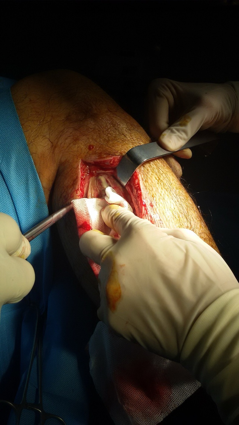 Figure 12. Fasciotomy for acute compartment syndrome - the limb-threatening end-point of an unrelieved tight cast. Source: Armin, via Wikimedia Commons, CC0 1.0.
