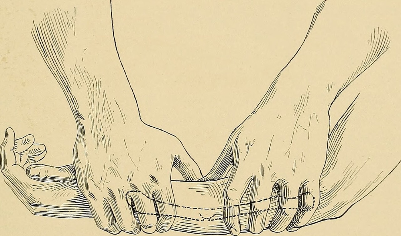 Figure 1. Closed reduction of a forearm fracture by manual manipulation - traction and moulding pressure applied by the surgeon’s hands. From C. L. Scudder, The Treatment of Fractures (1901). Public domain, via Wikimedia Commons.