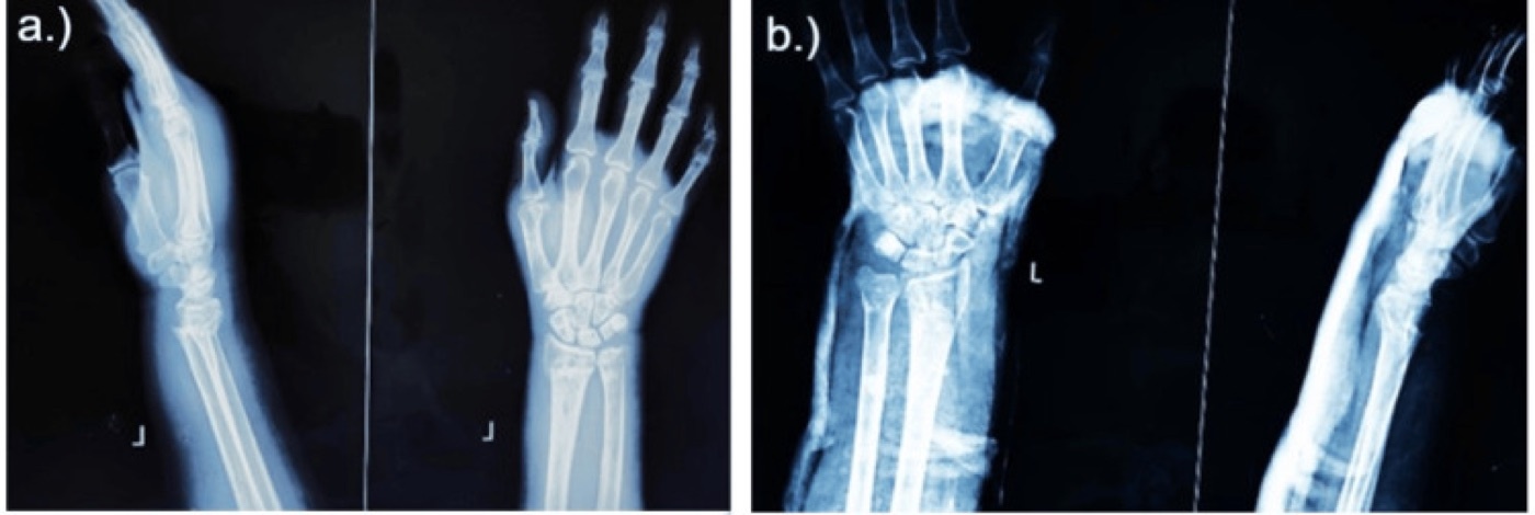 Figure 2. Distal-radius (Colles-type) fracture before (a) and after (b) closed reduction and cast application - the documented goal of a successful manipulation. From Kaushik et al. (2025), PMC12739557, CC BY 4.0.