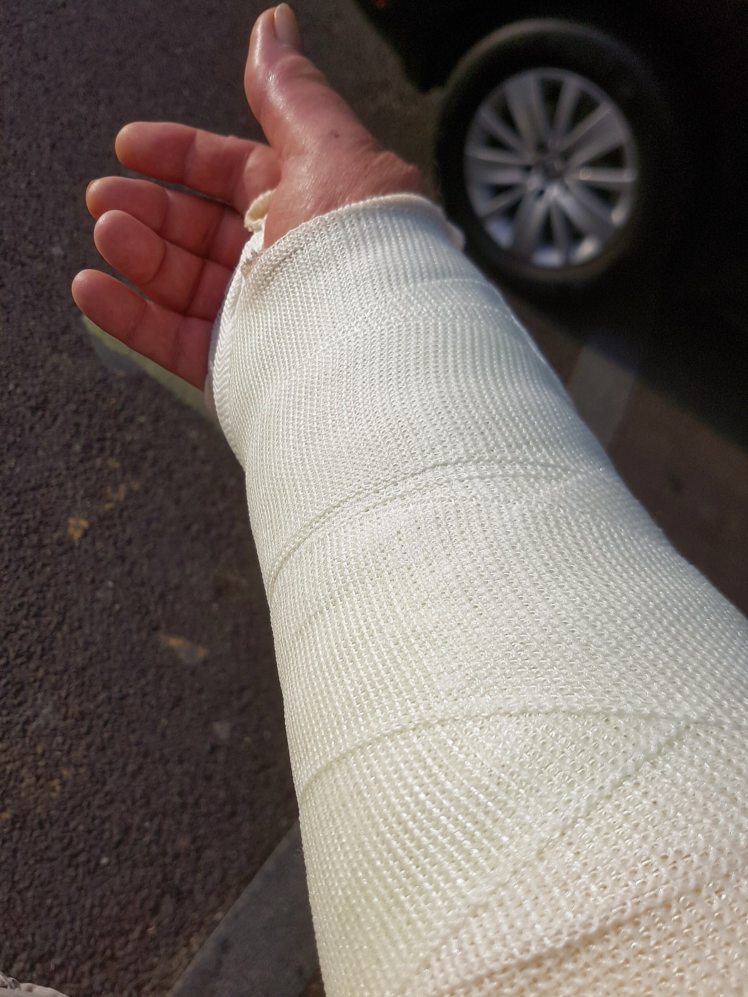 Figure 3. Synthetic (resin/fiberglass) short-arm cast for a wrist fracture - lighter and more radiolucent than plaster, favoured for definitive casts. Source: Acabashi, via Wikimedia Commons, CC BY-SA 4.0.