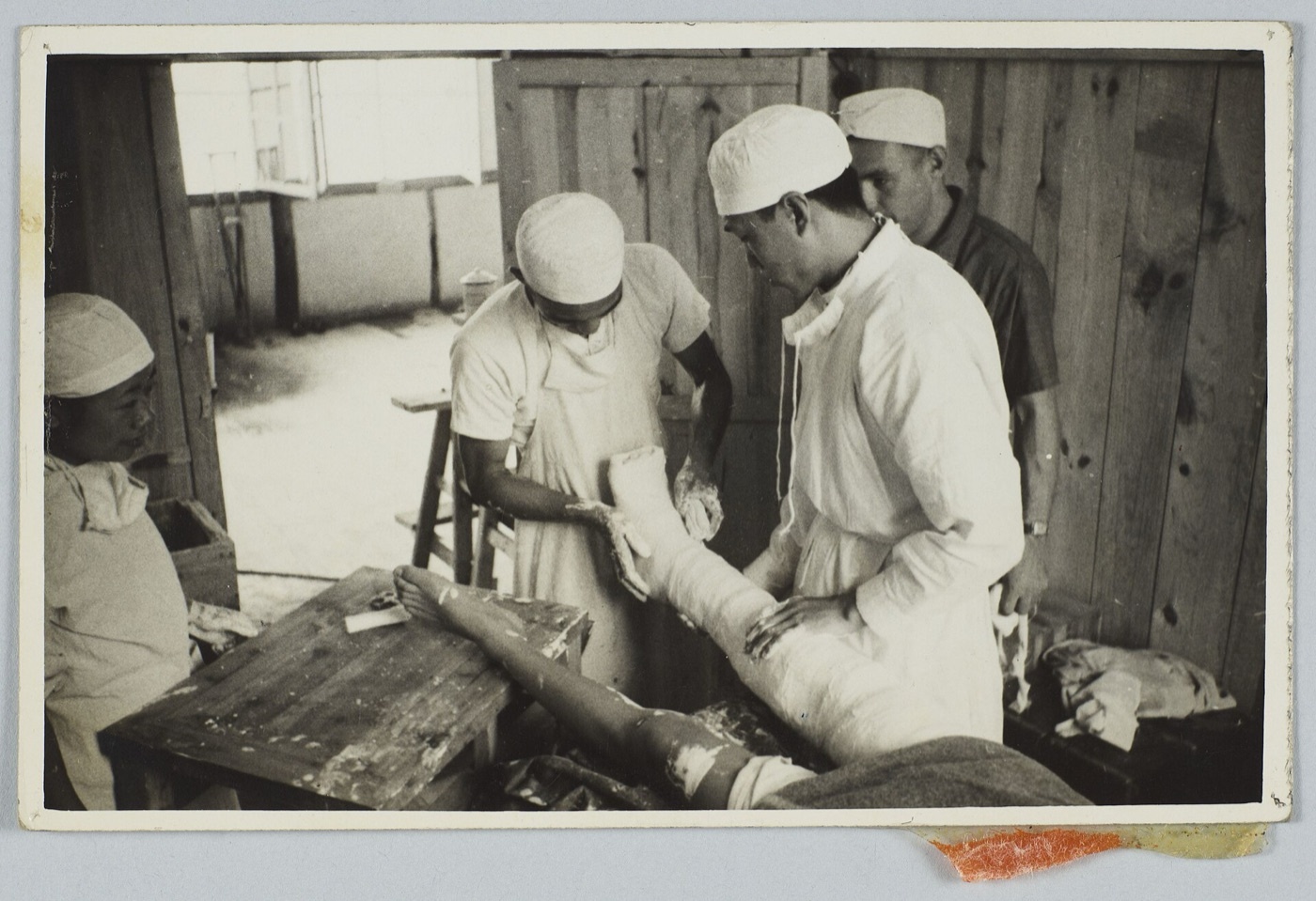 Figure 4. Application and moulding of a plaster-of-Paris cast to the leg over padding. IU Indianapolis University Library, via Wikimedia Commons. Public domain.