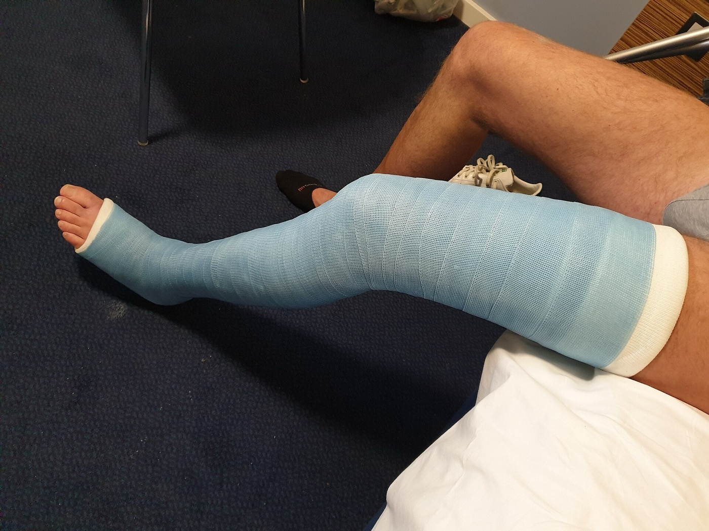 Figure 5. Long-leg fiberglass cast for a tibial fracture, with the knee in slight flexion and the foot plantigrade. Source: Jonuscumgi, via Wikimedia Commons, CC BY-SA 4.0.