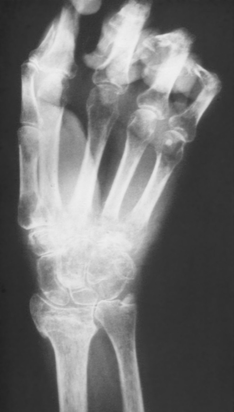 Figure 11. Sudeck’s atrophy: patchy juxta-articular osteopenia of the hand on radiograph. Source: Mehlauge, via Wikimedia Commons, CC BY-SA 3.0.
