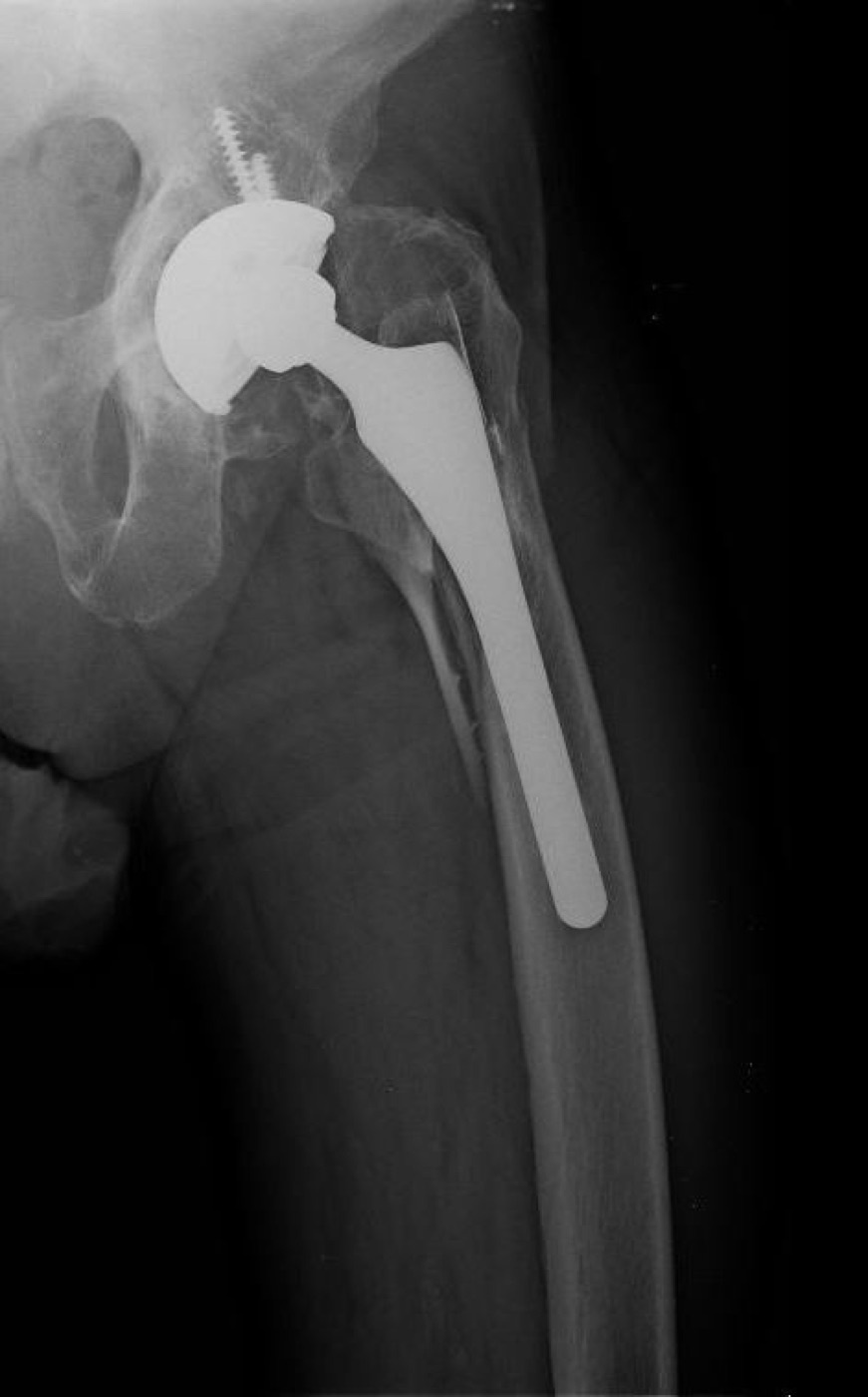 Figure 12. A periprosthetic femoral fracture about a hip stem (Vancouver type B). Source: Jmarchn, via Wikimedia Commons, CC BY-SA 3.0.