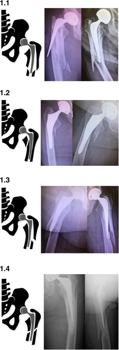 Figure 13. Vancouver type B2 sub-patterns of periprosthetic femoral fracture (schematics with matched radiographs); the loose stem is revised to a long stem. From Karam et al. (2020), J Orthop Surg Res, PMC7063746, CC BY 4.0.
