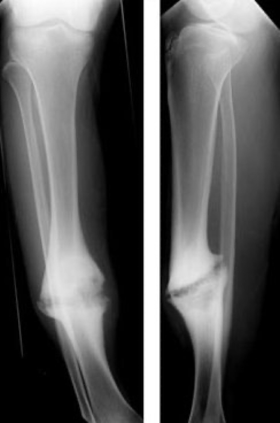 Figure 1. Hypertrophic (“elephant-foot”) non-union of the tibia: abundant callus with a persistent fracture line, a failure of stability rather than biology. Source: Lindsaydavidson, via Wikimedia Commons, CC BY 3.0.
