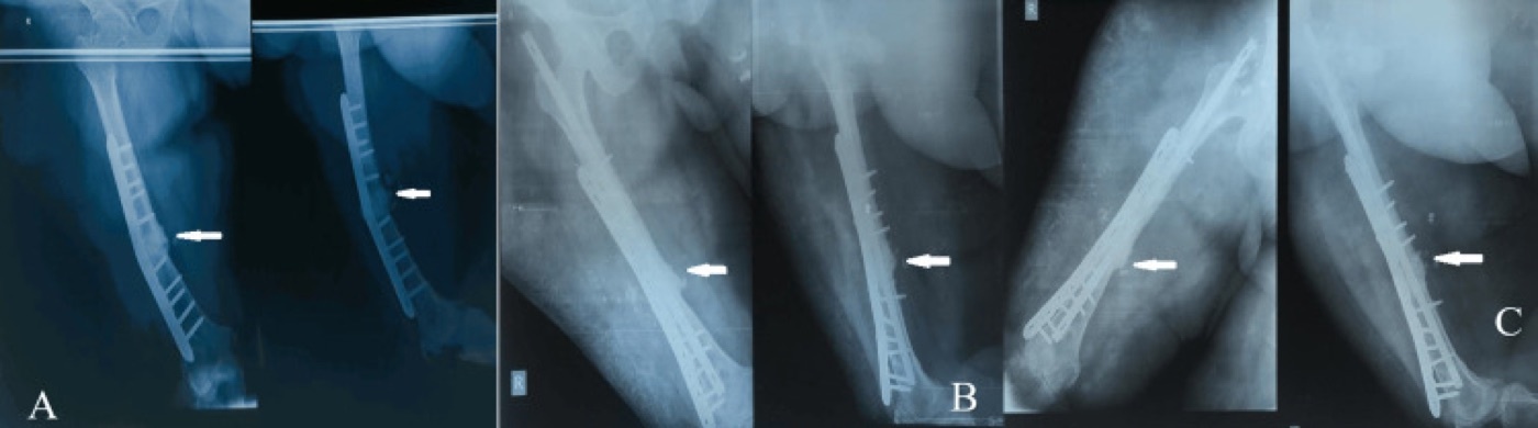 Figure 2. Atrophic non-union of the femur with implant breakage (A), revised with an exchange nail, plate and graft (B) and consolidated at three months (C). From Walia et al. (2024), Cureus, PMC11377906, CC BY 4.0.