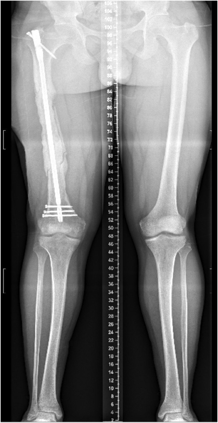 Figure 4. The Masquelet induced-membrane technique: a PMMA cement spacer bridging a large femoral segmental defect (stage 1), later replaced by cancellous graft within the induced membrane. From Kubes et al. (2021), Int J Surg Case Rep, PMC8219760, CC BY 4.0.