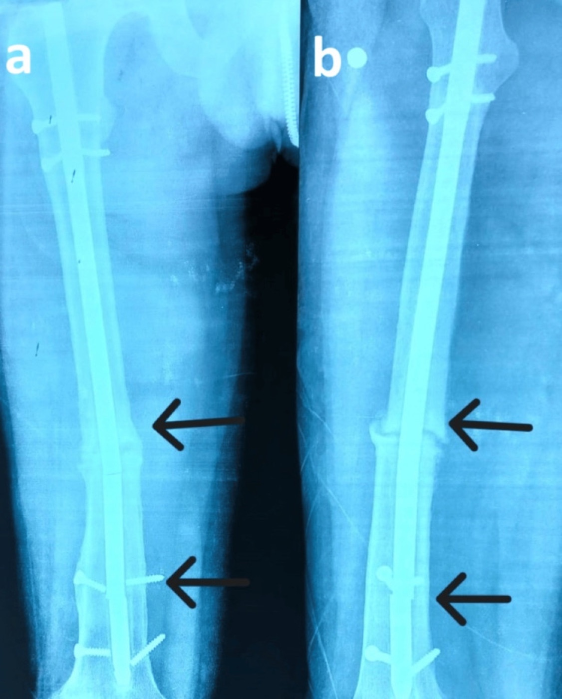 Figure 7. Hardware failure (“débricolage”): a femoral intramedullary nail fractured at two points over a non-union. From Durrani et al. (2025), Cureus, PMC12461672, CC BY 4.0.