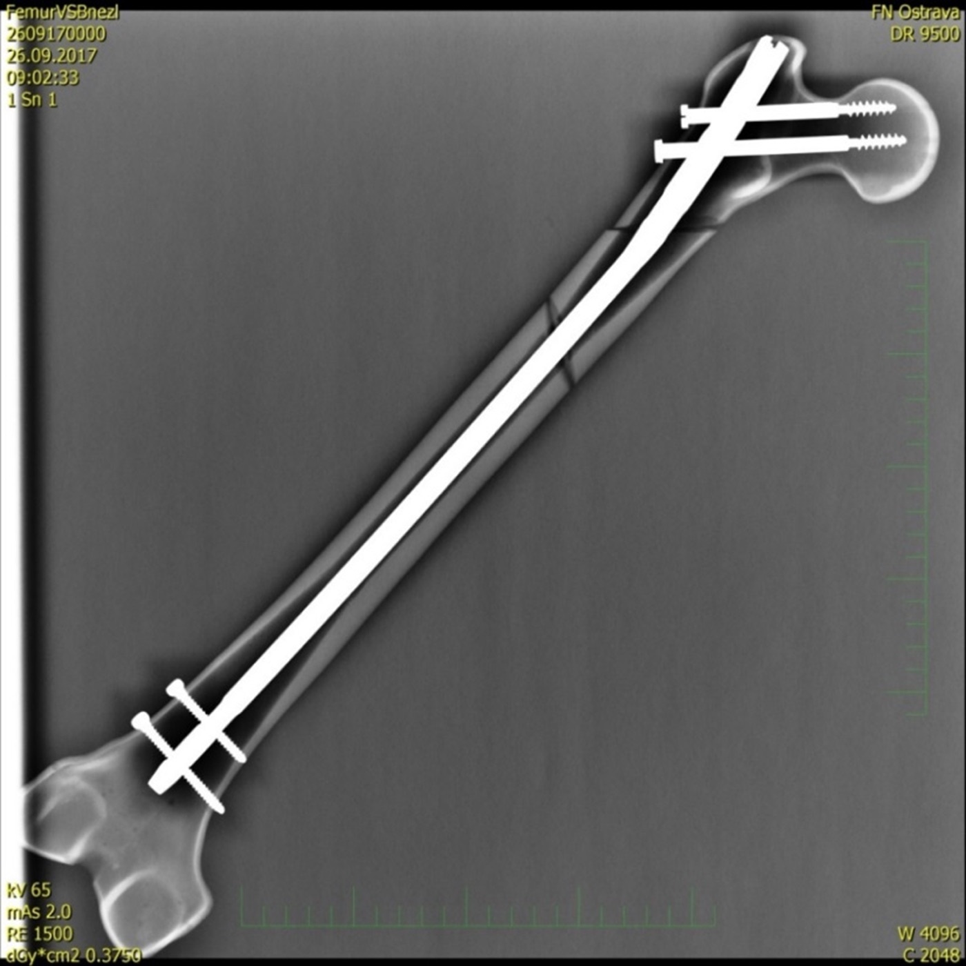 Figure 13. A femoral shaft fracture fixed with an antegrade intramedullary nail and proximal and distal interlocking screws. Source: Fry72 / Karel Frydrýšek, via Wikimedia Commons, CC BY-SA 4.0.