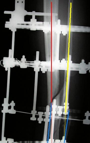 Figure 15. A tibia in an Ilizarov circular (ring) fixator: rings connected by threaded rods and stabilised by tensioned transfixion wires, the construct that gives stable fixation even in osteopenic bone and enables distraction osteogenesis. Source: Viapastrengo, via Wikimedia Commons, CC BY-SA 3.0.