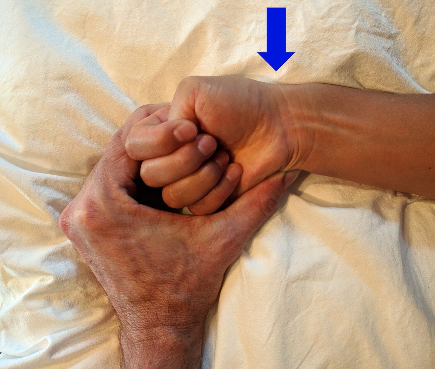 Figure 11. The Finkelstein/Eichhoff manoeuvre for de Quervain tenosynovitis; the arrow marks pain at the radial styloid (first dorsal compartment). Source: James Heilman, MD, via Wikimedia Commons, CC BY-SA 4.0.