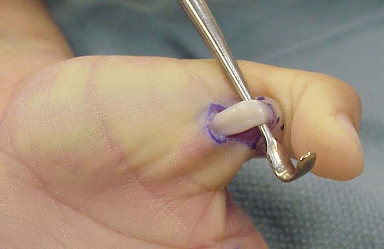 Figure 12. Open A1 pulley release for trigger digit: the flexor tendon exposed at the base of the thumb after incising the A1 pulley. Source: JoJoEMC, via Wikimedia Commons, CC BY-SA 3.0.