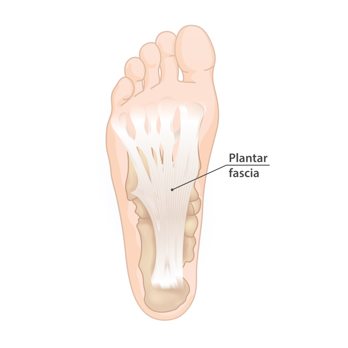 Figure 15. The plantar fascia, fanning from the medial calcaneal tubercle (the site of the enthesopathy) to the metatarsal heads. Source: InjuryMap, via Wikimedia Commons, CC BY-SA 4.0.