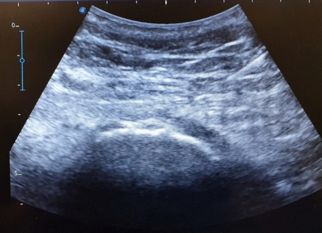 Figure 16. Ultrasound of the greater trochanteric region showing the gluteal tendon over the trochanteric cortex, the lesion underlying greater trochanteric pain syndrome. From Donati et al. (2025), PMC13241414, Fig. 2, CC BY 4.0.