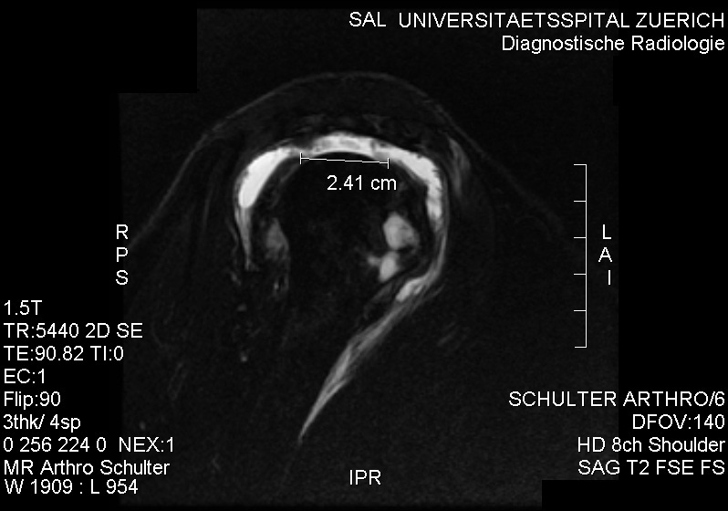 Figure 6. Sagittal MR arthrogram of a full-thickness supraspinatus tear (transmural gap). Source: RSatUSZ, via Wikimedia Commons, CC BY-SA 3.0.