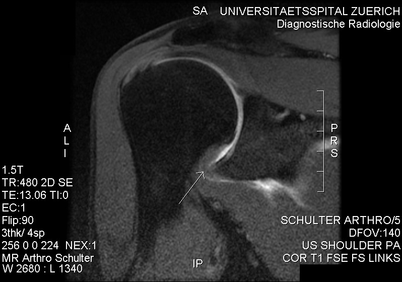 Figure 7. Coronal MR arthrogram in adhesive capsulitis: a thickened joint capsule at the inferior axillary recess (arrow). Source: RSatUSZ, via Wikimedia Commons, CC BY-SA 3.0.